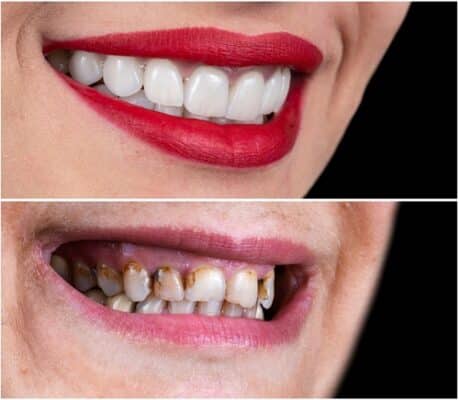 Dental Bonding in Winston-Salem, NC | Book a Consultation