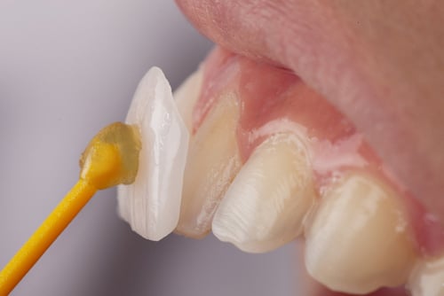 Dental Veneers in Winston-Salem, NC, | Book a Consultation