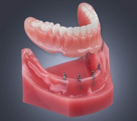 What Is All-on-4 Dental Implants in Winston-Salem
