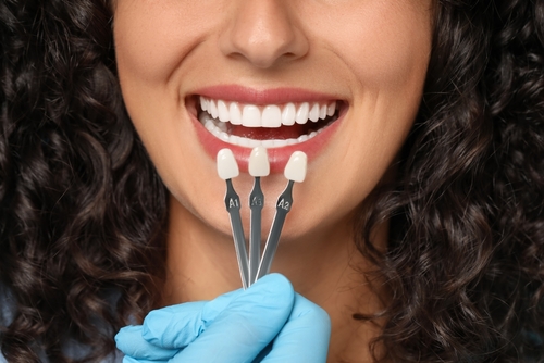Porcelain Veneers in Winston-Salem, NC | Book a Consultation