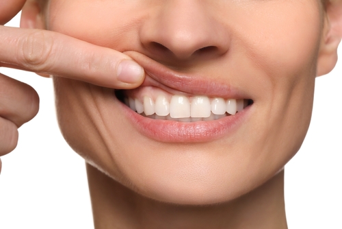 Periodontal Disease in Winston-Salem, NC | Bleeding Gums