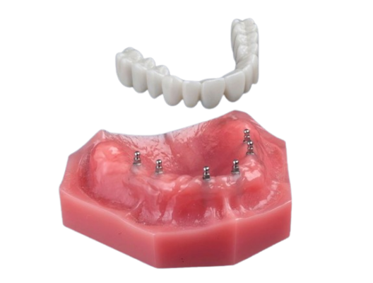Fix-on-Six in Winston-Salem, NC | Mini Implants for Dentures