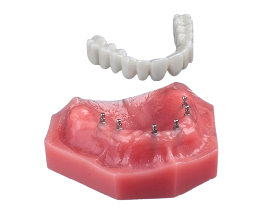 Fix-on-Six in Winston-Salem, NC | Mini Implants for Dentures
