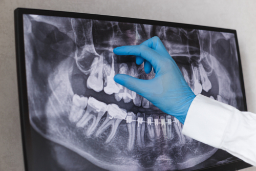 Root Canal Treatment in Winston-Salem, NC | Affordable Care 🦷