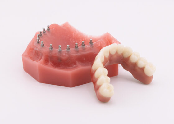 Full Mouth Implants in Winston-Salem, NC | Affordable Implants!