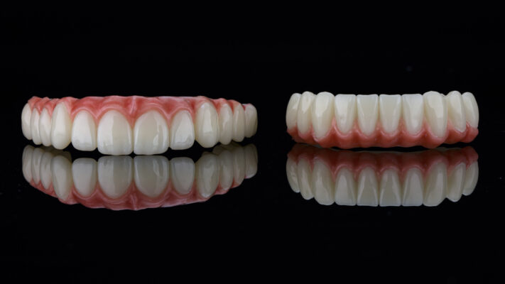 Permanent Dentures in Winston-Salem, NC | Affordable Implants