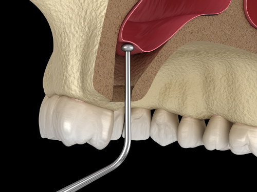 Sinus Lift in Wiston-Salem, NC | Affordable Sinus Lift and Implants