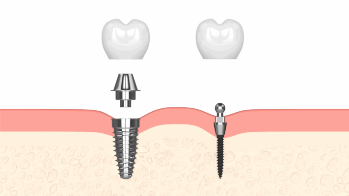 Mini Dental Implant in Winston-Salem, NC | Affordable Implants