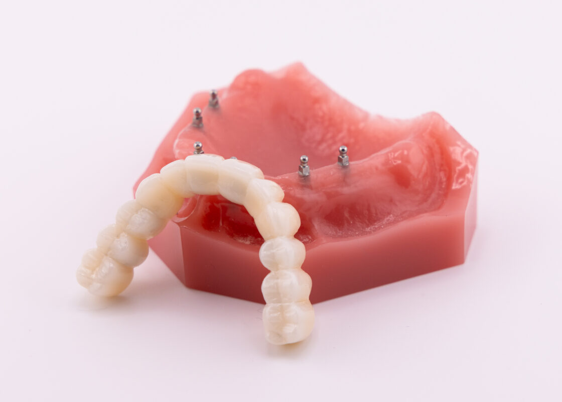 Roundhouse Bridge in Winston-Salem, NC | Affordable Dentures