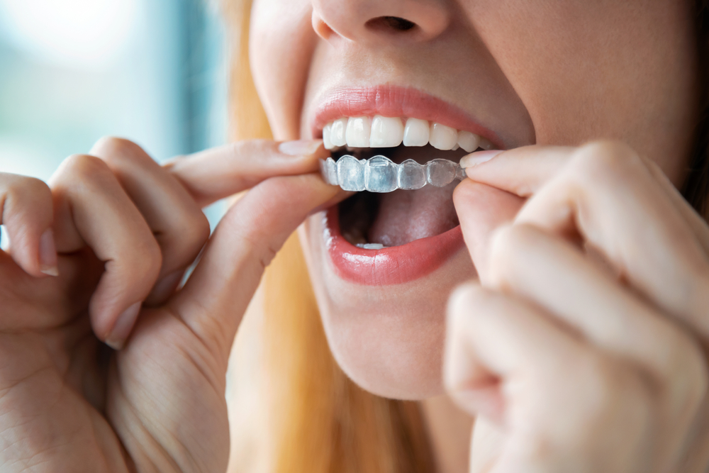 Clear Aligners in Winston-Salem, NC | Affordable Braces Alternative