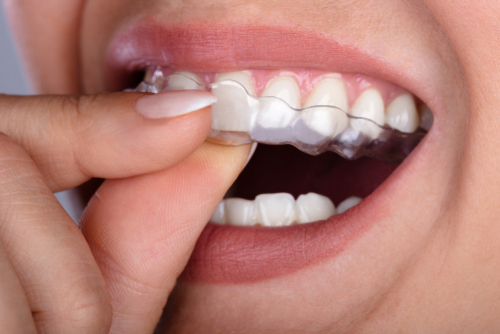 Clear Aligners in Winston-Salem, NC | Consult an Invisalign Dentist