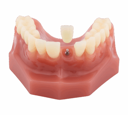 Mini Implant in Winston-Salem, NC | Affordable Dental Implants 🦷