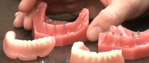 Snap-On Dentures in Winston-Salem, NC | Mini Implant Dentures