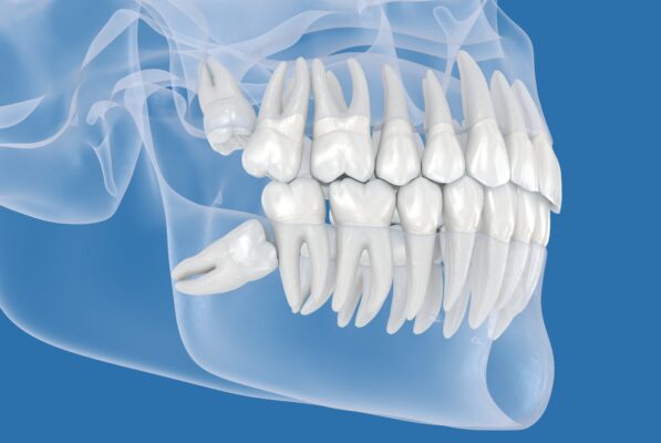 Wisdom Tooth Extraction in Winston-Salem, NC | Affordable Care