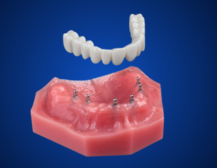 Same-Day Teeth in Winston-Salem, NC | Dental Implant Consults