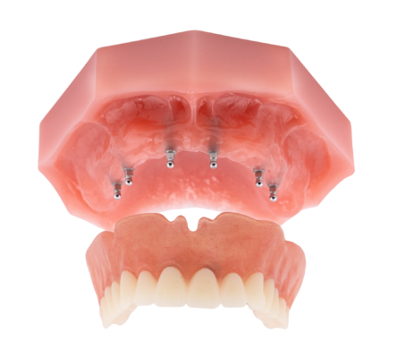 Snap In Dentures in Winston-Salem | Mini Implants [Video Inside]