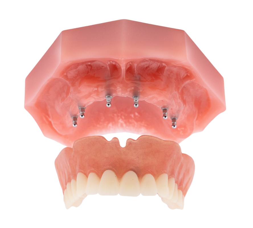 Snap In Dentures in Winston-Salem | Mini Implants [Video Inside]