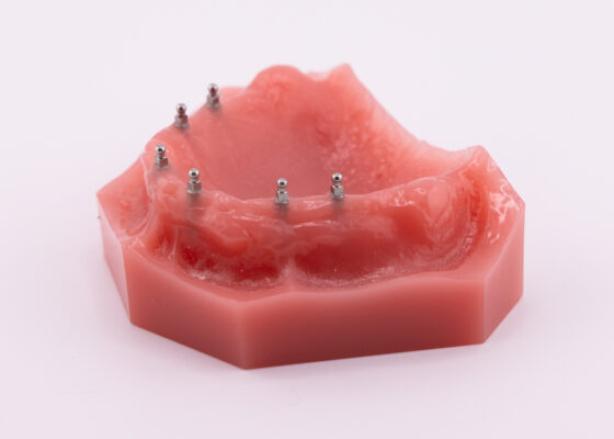 Dental Implant Guide in Winston-Salem [Video Walkthrough]