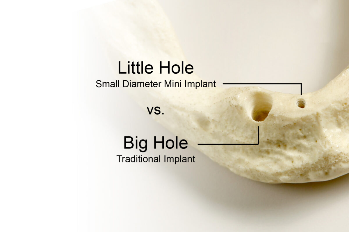 Minimally Invasive Dental Implants in Winston-Salem [Video Q&A]