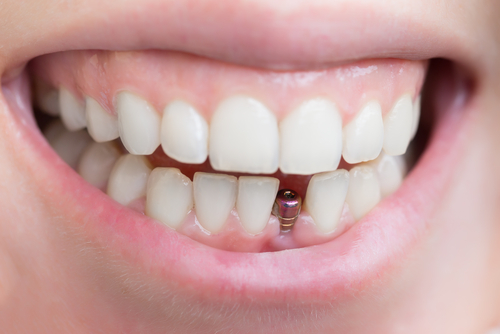 Best Implant Options in 2026 in Winston-Salem, NC [Video Q&A]