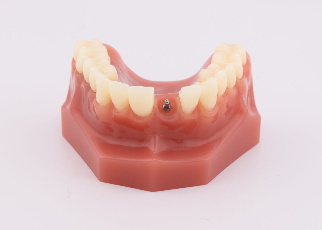 Dental Extraction in Winston-Salem | Implant Consults [Video Q&A]