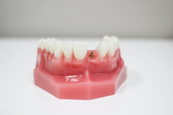 Mini Dental Implant in Winston-Salem, NC | Affordable Implant Consult