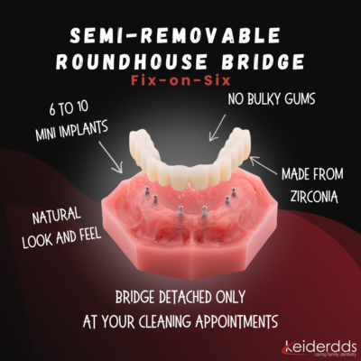 Fixed Teeth in Winston-Salem | Mini Implant Denture [Video Guide]