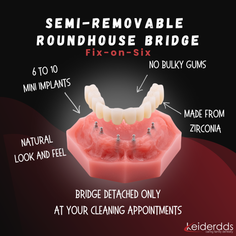 Fixed Teeth in Winston-Salem | Mini Implant Denture [Video Guide]