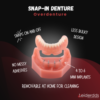 Snap-In Denture in Winston-Salem | Implant Denture Options
