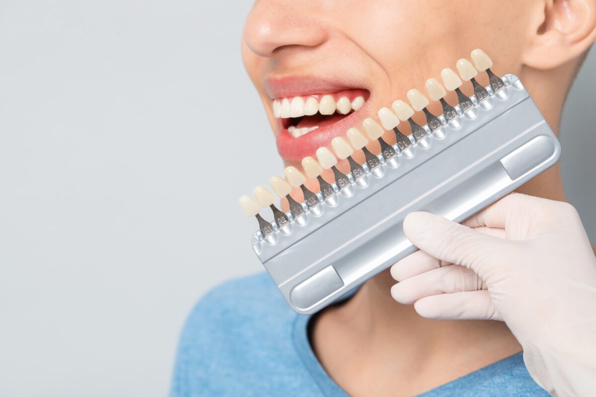 Veneers Payment Plan in Winston-Salem, NC [Quick Video Tips]