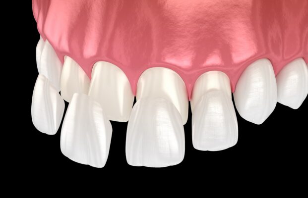 Veneers on Front Teeth in Winston-Salem [Video Q&A]