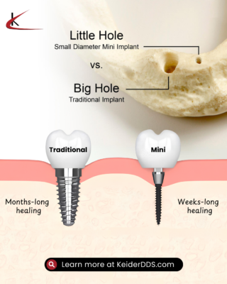 Mini Implants vs. Conventional Implants | Affordable Consultation