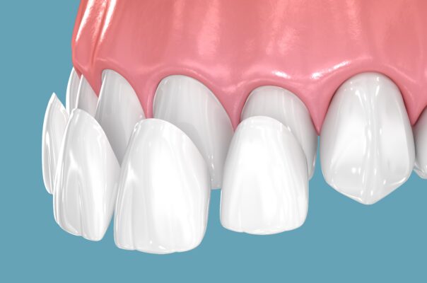 Porcelain Veneers in Winston-Salem | Cosmetic Dentistry