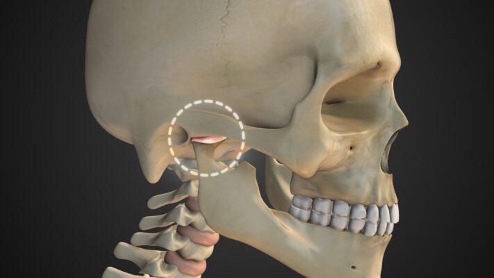 TMJ Splint in Winston-Salem, NC | Night Guard [Video Guide]