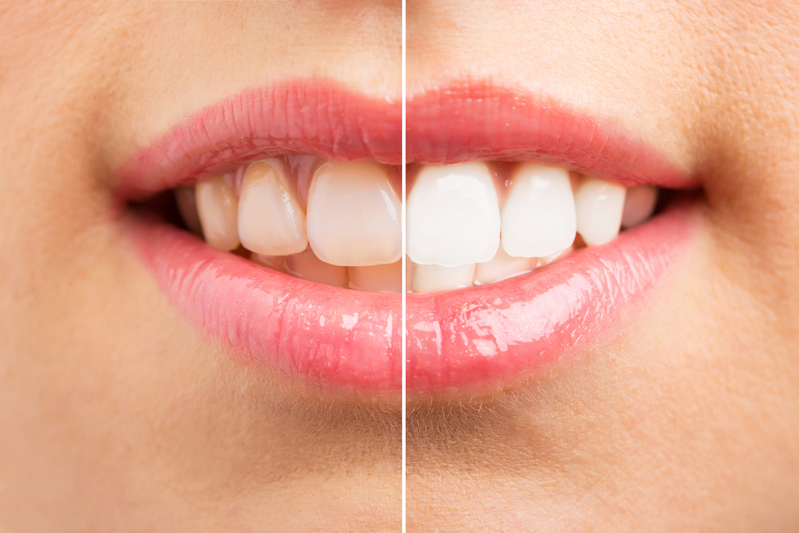 Teeth Whitening Services in Winston-Salem [Video Explainer]😁✨