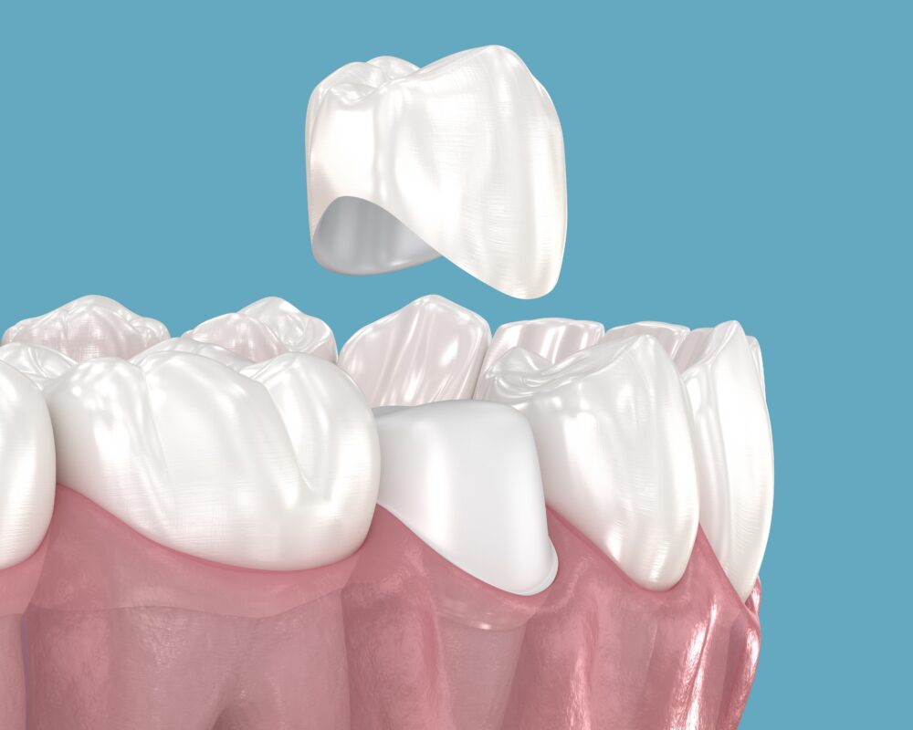 Veneers vs. Crowns in Winston-Salem, NC [Video Explainer] 😁✨
