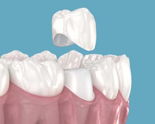Veneers vs. Crowns in Winston-Salem, NC [Video Explainer] 😁✨
