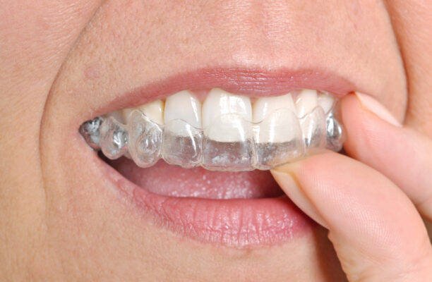 Braces Alternatives in Winston-Salem [Video Inside]