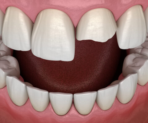 Broken Tooth in Winston-Salem | Call for Urgent Care [Video Q&A]