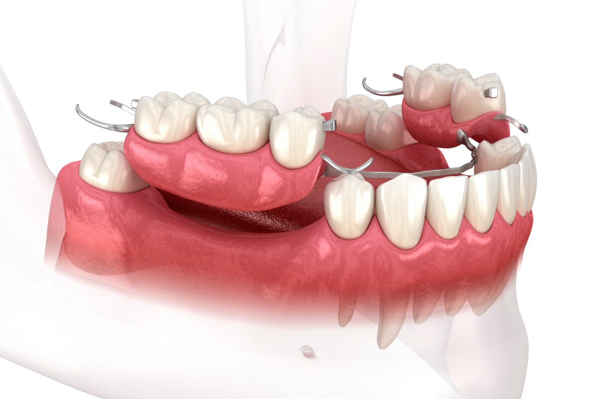 Dental Bridges vs. Partial Dentures in Winston-Salem, NC [Video]