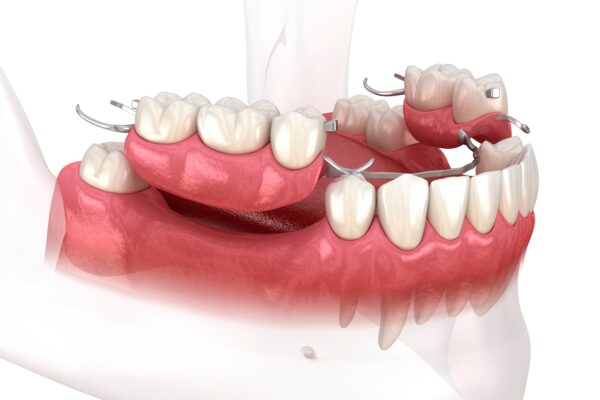 Dental Bridges vs. Partial Dentures in Winston-Salem, NC [Video]