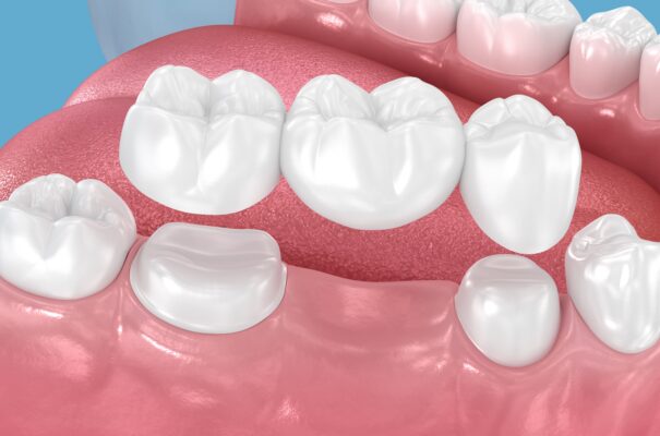 Traditional Dental Bridge in Winston-Salem | Affordable Consults