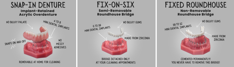 Denture Alternatives in Winston-Salem, NC | Affordable Consults
