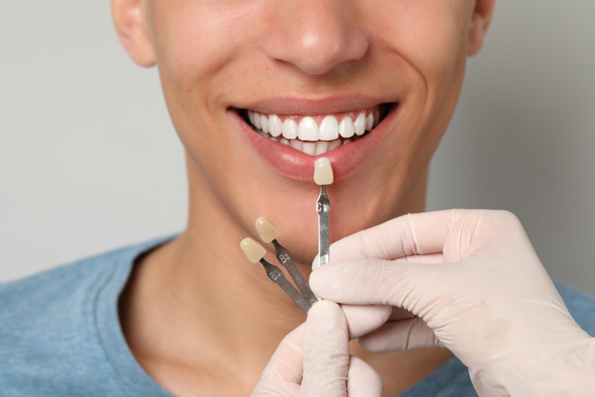 Teeth Whitening Cost in Winston-Salem | $199 [Watch the Video]